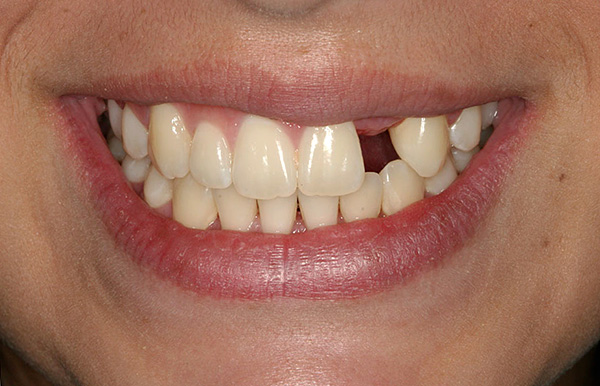 يمكن أن يؤثر فقدان الأسنان حتى بدون الأسنان الاصطناعية في الوقت المناسب بشكل سلبي جدًا على حالة الأسنان بأكملها.