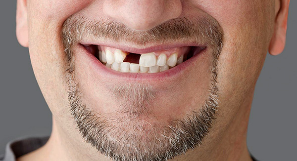 Die Preise für Zahnprothesen können sehr unterschiedlich sein, manchmal mehrmals, abhängig von einer Reihe von Faktoren ...