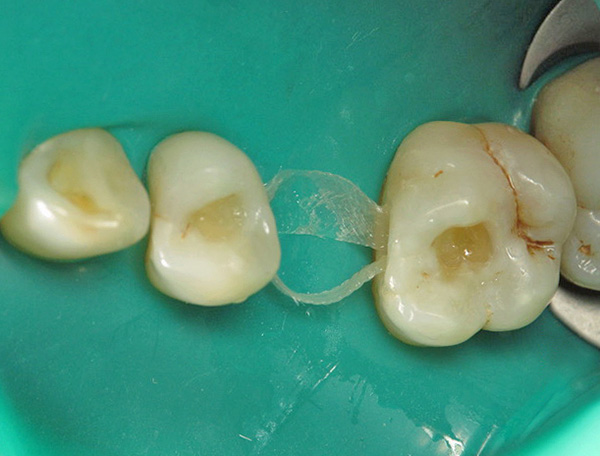 Између зуба протеже се фибергласова база будуће протезе.