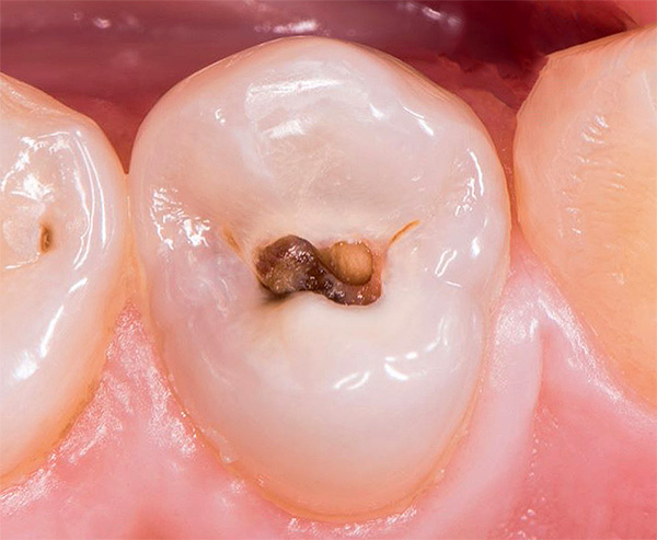 Amb càries moderades, el procés de destrucció afecta no només l’esmalt dental, sinó també la dentina que hi ha a sota ...