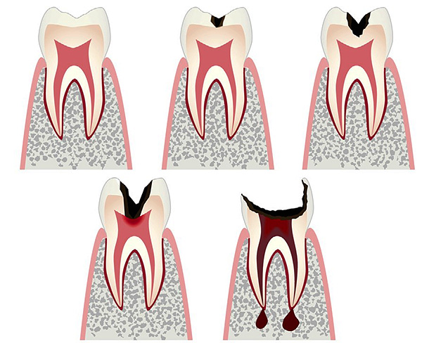 Komplikasyonlara geçiş ile çürük sürecin gelişim aşamaları - pulpitis ve periodontitis.