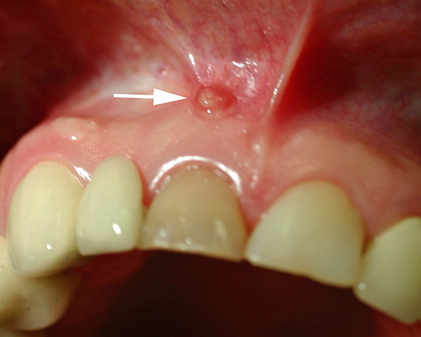 Caur fistulu, kas atrodas uz smaganas virs zoba, strutas tiek evakuētas mutes dobumā.