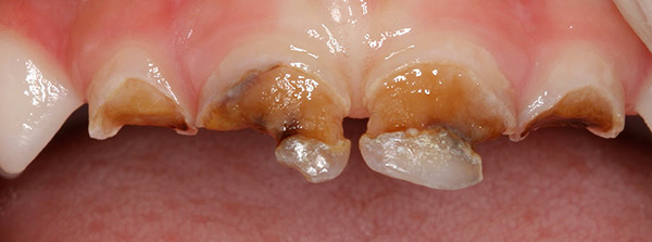 La falta de un tratamiento oportuno de la caries de los dientes de hoja caduca en un niño puede causar graves daños a la salud del bebé en general.