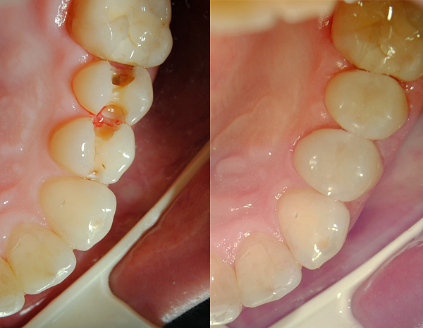 Užpildymo medžiaga vizualiai praktiškai nesiskiria nuo natūralių danties audinių.