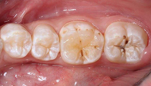 Fissures of the chewing teeth are often affected by caries, since there is an accumulation of food debris.