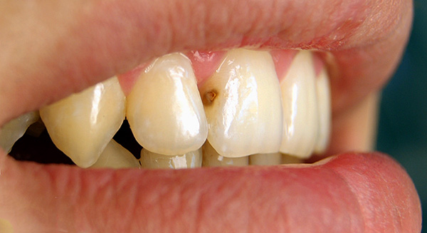Middle caries on the front tooth