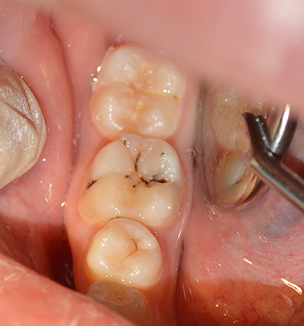 Кариозен процес в областта на фисурата на долния дъвкателен зъб.