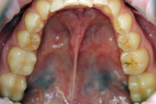 Karioisesta prosessista johtuva hampaiden rappeutumisnopeus on erilainen kaikille ihmisille, ja se riippuu monista tekijöistä, mukaan lukien kehon yksilölliset ominaisuudet.