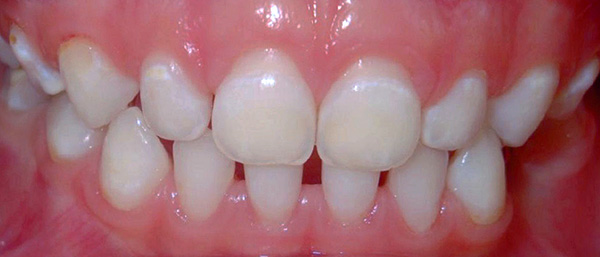 จุดสีขาวเป็นพื้นที่ของการเคลือบฟันแบบไร้แร่ธาตุ