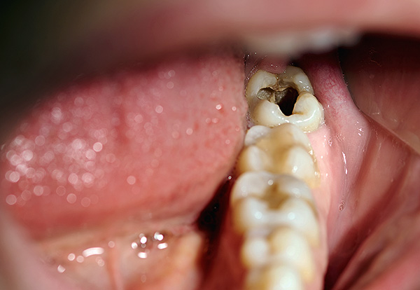 Hluboký zubní kaz dolního žvýkacího zubu.