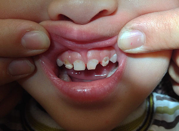Sui modi per alleviare il mal di denti nei bambini ...