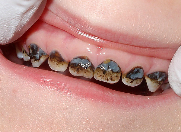Els efectes de la plata dentada