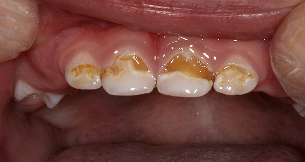 Amb danys profunds a l’esmalt, una varietat d’irritants pot causar mal de mal de dents: químic, de temperatura i mecànic.