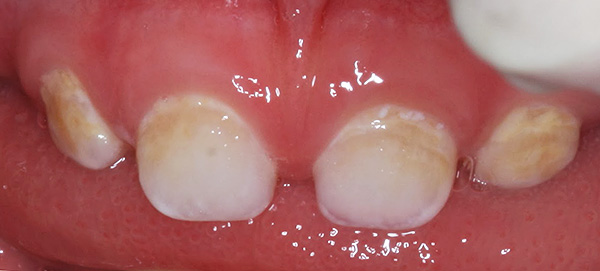 تسوس الأسنان اللبنية في مرحلة بقعة بيضاء (طباشير).