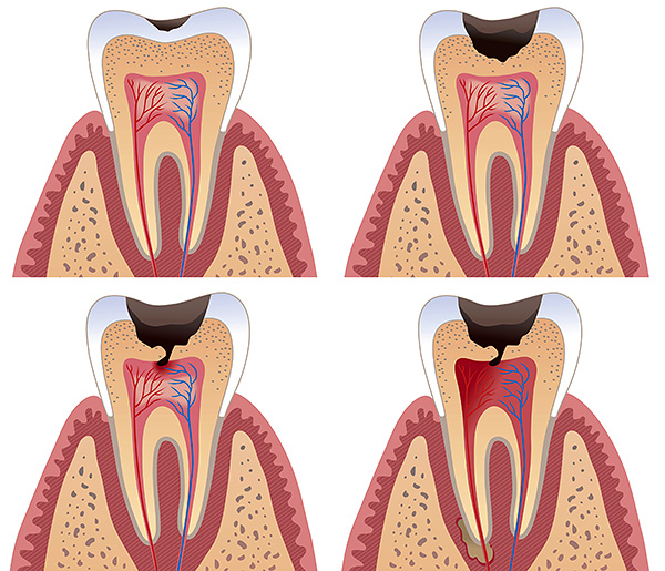 كلما تأخرت زيارة طبيب الأسنان لفترة أطول ، ستكون هناك حاجة إلى علاج أكثر تعقيدًا وطولًا.