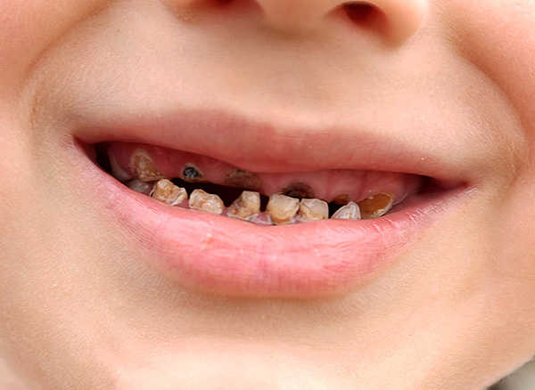 Si no vigila l’estat de les dents en el nadó, pot formar complexos psicològics, que de vegades persisteixen durant molts anys.