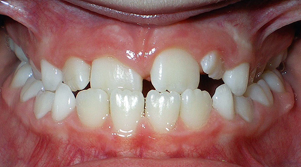 Malocluzia poate apărea, printre altele, din cauza pierderii premature a dinților de foioase distruse de carii.