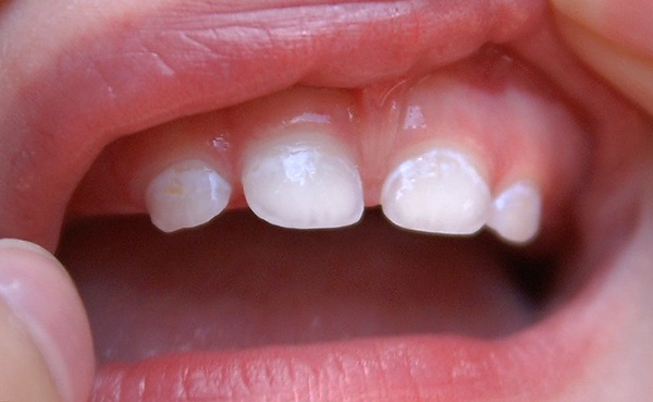 Demineralisering av tannemaljen i de første stadiene manifesterer seg med slike hvite flekker.