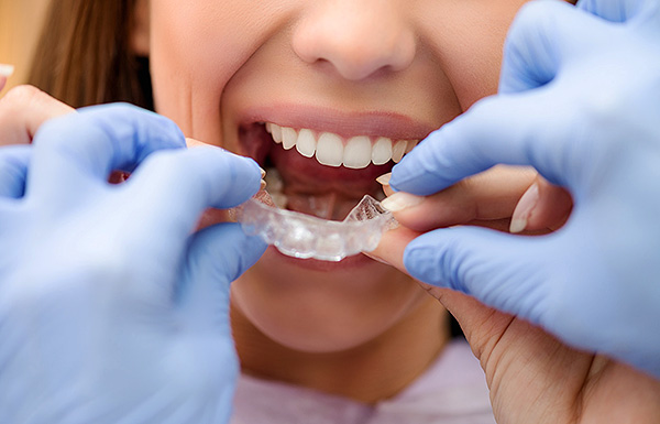 Parlons de la correction de la malocclusion à l'aide de divers capuchons orthodontiques ...