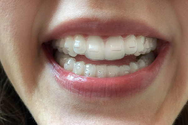 Τα ελαστικά στα δόντια, αν και αισθητά, δεν είναι πολύ εμφανή.