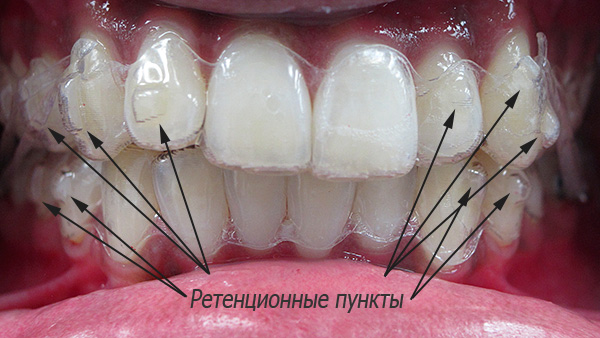 Retention points on teeth