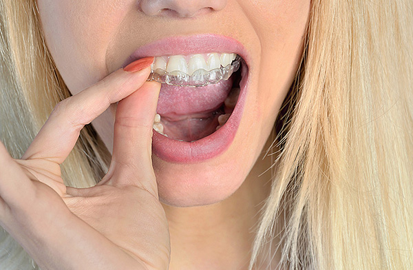 كلما كان علم الأمراض أقل وضوحًا ، ستكون هناك حاجة إلى غطاء أقل وأقصر مدة علاج تقويم الأسنان.