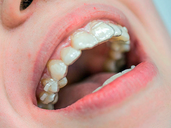 Ein solches Mundstück kann vom Arzt selbst hergestellt werden, um die Position eines oder mehrerer Zähne zu korrigieren ...