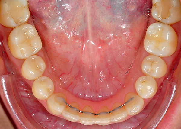 Dispositif de retenue sur les dents avant de la mâchoire inférieure.