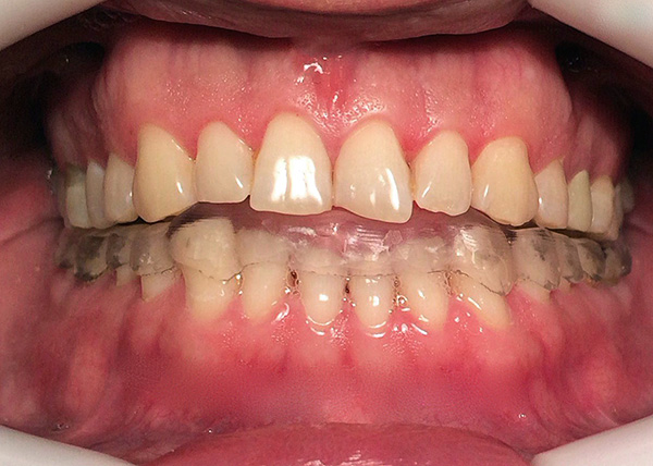 Fotoğraf, bir diş bölme lastiğinin bir örneğini göstermektedir.