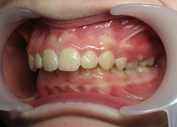 Неправилното положение на челюстите една спрямо друга може да се развие, включително поради проблеми с TMJ.