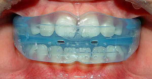 Un tel appareil est un protège-dents en silicone souple, qui permet de corriger la morsure due à une usure régulière.