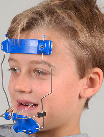 Usar un dispositivo extraoral de este tipo le permite empujar la mandíbula superior del niño hacia adelante.