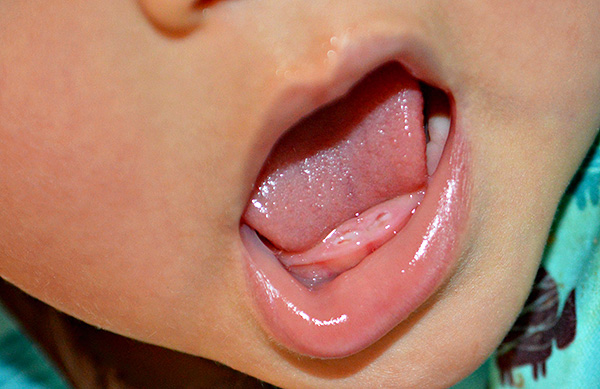 Redan i barndomen kan ett antal faktorer ha en negativ effekt på barnets mjölkbett.