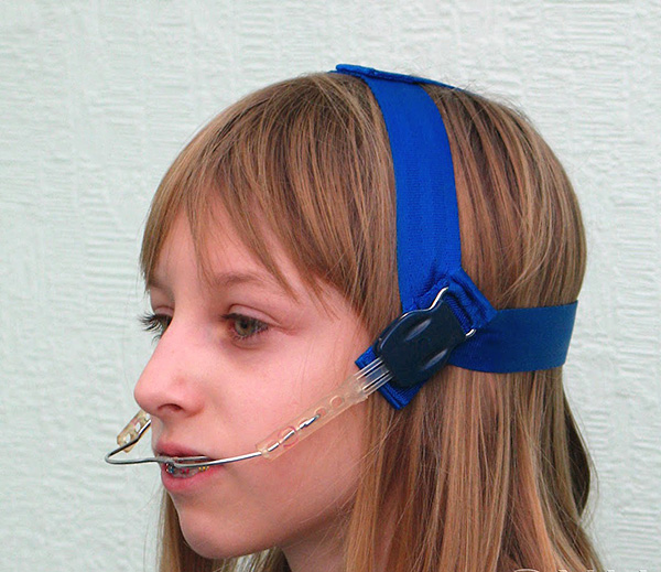 L’arc facial és un dispositiu molt senzill però molt eficaç per corregir la picada.