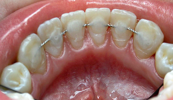 This is how an orthodontic retainer looks like
