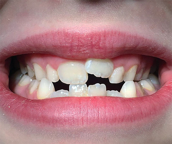 Various types of removable orthodontic appliances allow you to effectively smooth out the bite in babies, even in very difficult clinical cases ...