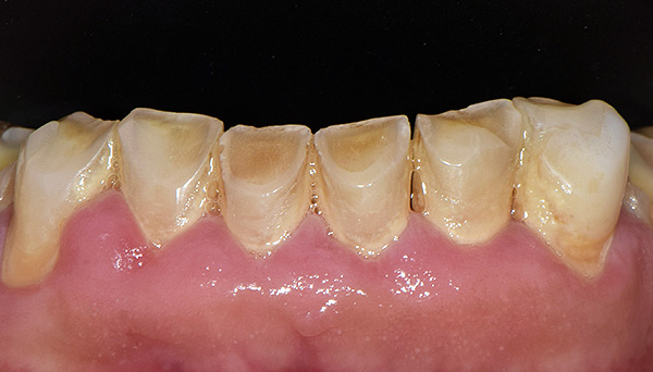 Eine falsche Okklusion führte zu einem pathologischen Abrieb der unteren Schneidezähne und Zähne.