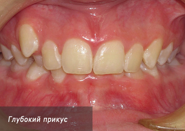 Dengan gigitan yang mendalam, incisors yang lebih rendah seringkali mencederakan langit.