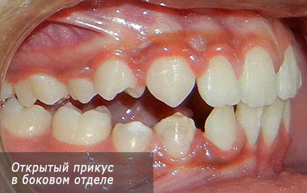 Morsure ouverte dans la dentition latérale.
