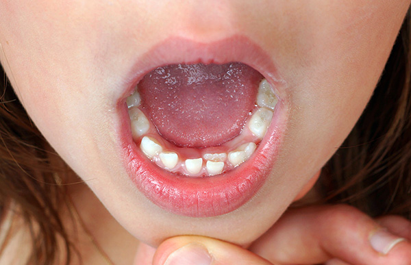 En changeant les dents de lait en dents permanentes, on peut souvent déjà voir des signes de problèmes futurs avec une morsure ...
