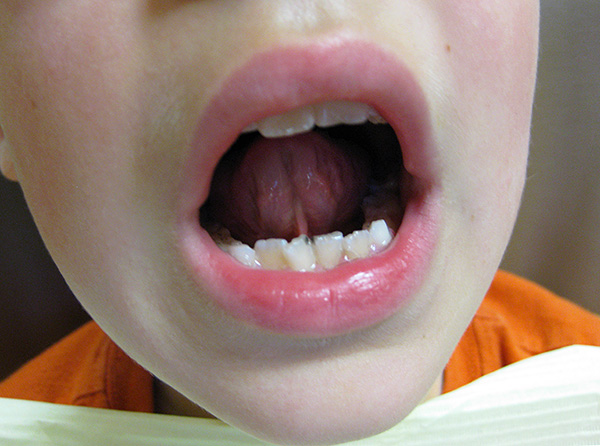 Paauglių brendimo laikotarpiu yra aktyvus viso dantų restruktūrizavimo etapas.