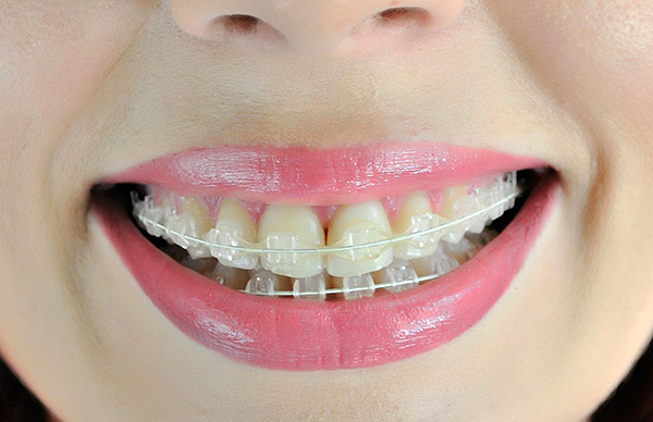 Safīra bikšturi, salīdzinot ar metālu, uz zobiem ir salīdzinoši neredzami.
