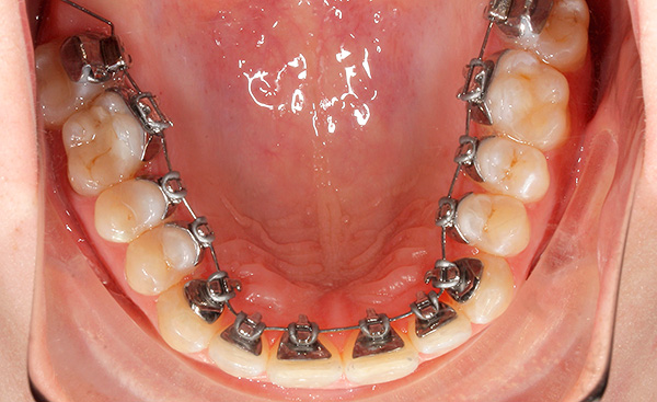2D lingual braces.