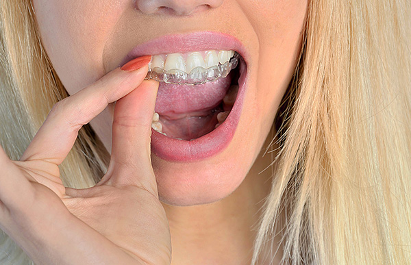Tak wygląda ortodontyczny ustnik do wyrównania zgryzu zębów stałych.