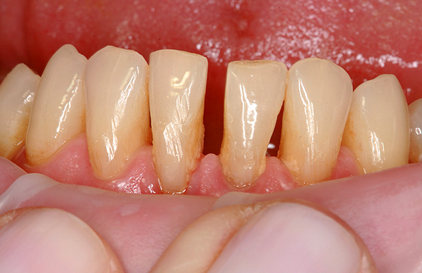 Zahnfleischrezession vor dem Hintergrund der Parodontitis.