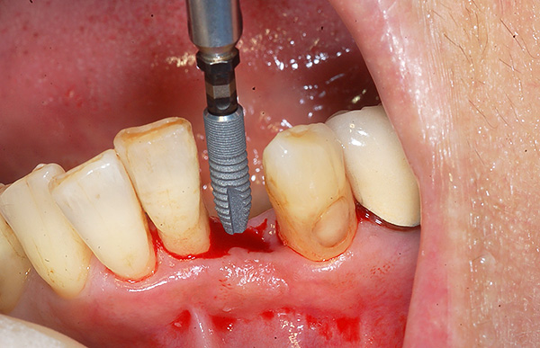 Mit dem Verlust eines Zahns ist die beste Option für die Prothetik normalerweise die Zahnimplantation.
