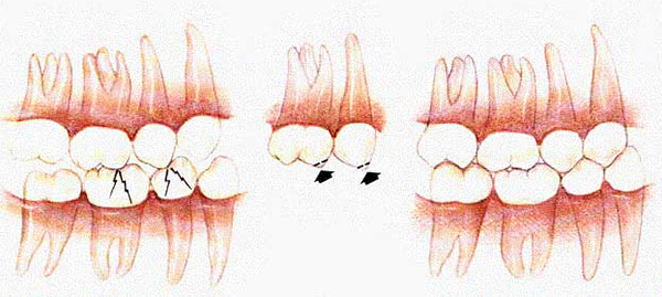 Η εξάλειψη των δεσμών οδοντικών επαφών.