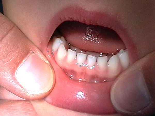 Jurang besar antara gigi bayi bukan patologi.