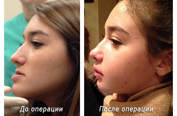 The result of orthognathic surgery: left - before surgery, right - after.