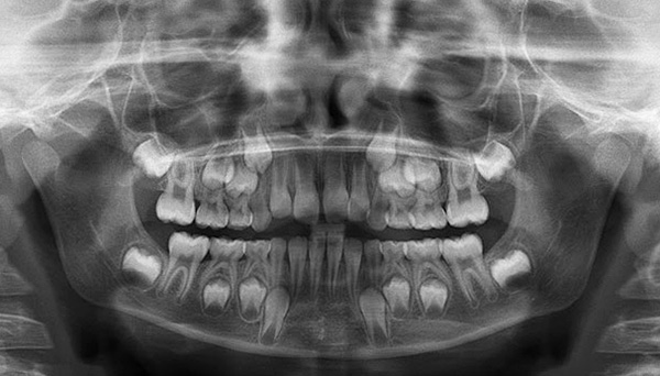 Taip rentgenogramoje atrodo nuolatinių dantų užuomazgos.